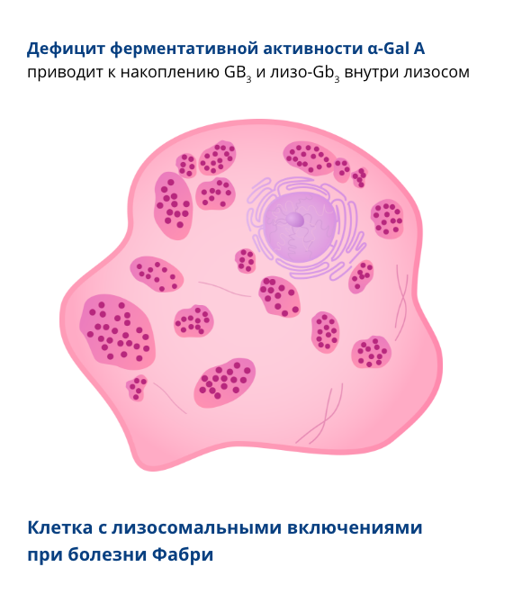 Клетка с лизосомальными включениями 
					  при болезни Фабри