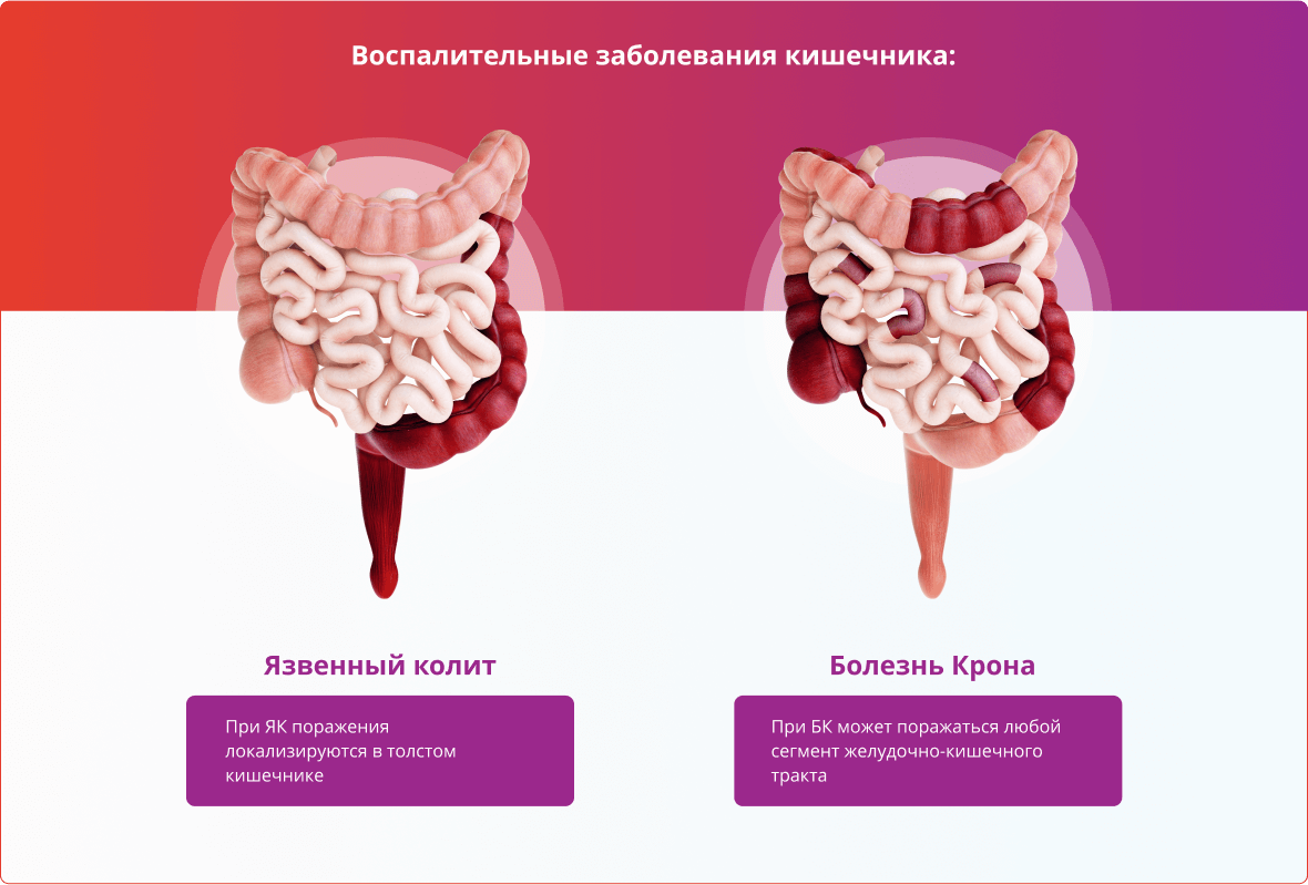 Воспалительные заболевания кишечника