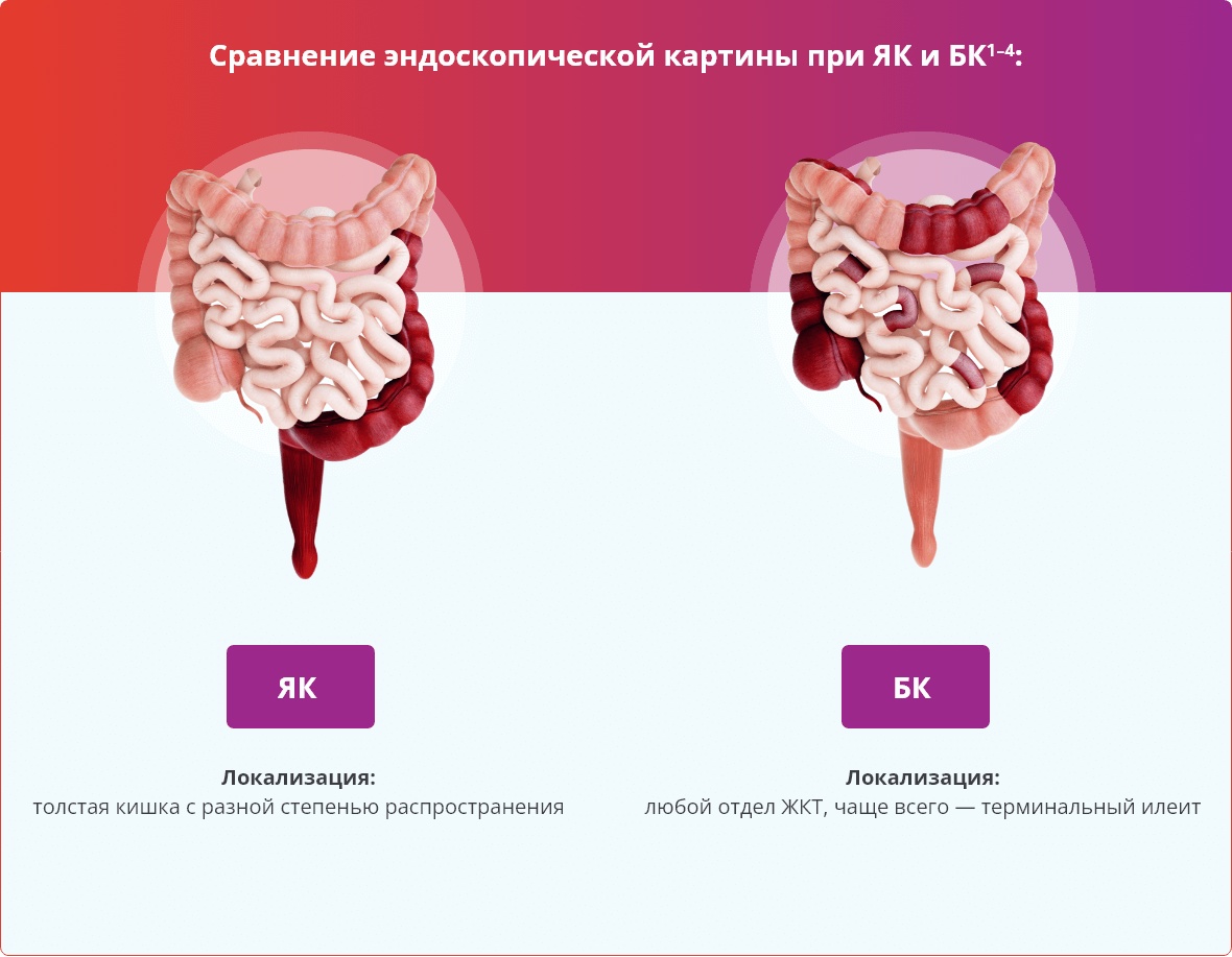 Сравнение эндоскопической картины при ЯК и БК